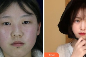 晉城鳳凰整形美容醫(yī)院尹琥珠整形價(jià)格表附開內(nèi)眼角案例展示