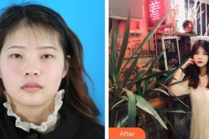 晉城星范醫(yī)療美容診所趙艷整形價(jià)格表附埋線雙眼皮案例展示