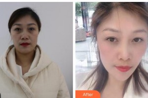 晉城俏麗醫(yī)療美容門診部杜銀燕整形價(jià)格表附眼部綜合案例展示