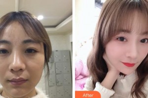 晉城鳳凰整形美容醫(yī)院宋發(fā)興整形價(jià)格表附定點(diǎn)雙眼皮案例展示