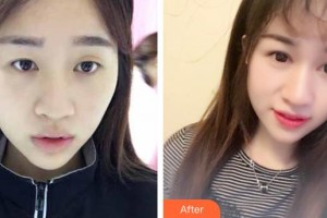 晉中鷹華眼科醫(yī)院郭新整形價格表附切開雙眼皮案例展示