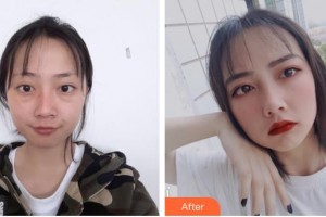 晉中鷹華眼科醫(yī)院錢軍整形價(jià)格表附眼部綜合例展示