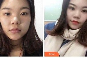 晉中鷹華眼科醫(yī)院史彩霞整形價格表附切開雙眼皮案例展示