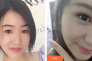 晉中鷹華眼科醫(yī)院王生英整形價格表附切開雙眼皮案例展示