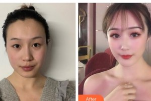 運(yùn)城市第一醫(yī)院燒傷整形美容科郭靜整形價格表附自體脂肪全臉填充案例展示