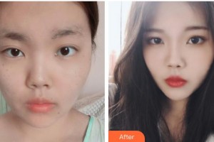 運(yùn)城麗都整形美容醫(yī)院彭元整形價(jià)格表附光子嫩膚案例展示