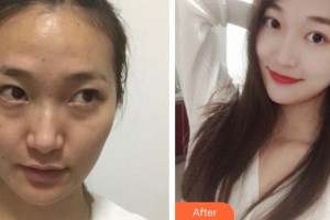 運(yùn)城市中心醫(yī)院整形外科岳長(zhǎng)路整形價(jià)格表附激光點(diǎn)痣案例展示