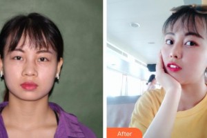 運(yùn)城華美醫(yī)學(xué)美容醫(yī)院李彥海整形價(jià)格表附鼻部綜合案例展示