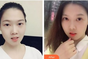 運(yùn)城薛大夫整形美容門診部刑新整形價(jià)格表附定點(diǎn)雙眼皮案例展示