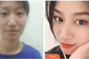 運(yùn)城光子醫(yī)療美容門診部李守義整形價(jià)格表附眼部綜合案例展示