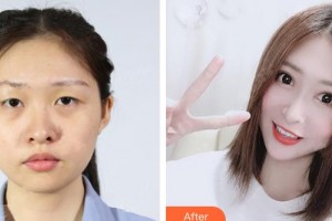 九江瑞麗醫(yī)療美容醫(yī)院殷運(yùn)城整形價(jià)格表附眼部綜合案例展示