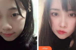 運(yùn)城薛大夫整形美容門(mén)診部李彬整形價(jià)格表附眼部綜合案例展示