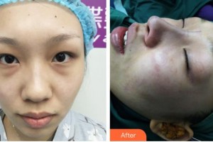 運(yùn)城華美醫(yī)學(xué)美容醫(yī)院劉安堂整形價(jià)格表附耳軟骨復(fù)合隆鼻案例展示