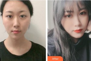 運(yùn)城光子醫(yī)療美容門(mén)診部郝睿鵬整形價(jià)格表附激光祛斑案例展示