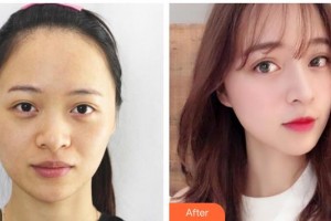 運(yùn)城華美醫(yī)學(xué)美容醫(yī)院徐健帆整形價(jià)格表附清潔祛痘案例展示