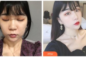 運(yùn)城麗霞醫(yī)療美容診所孫肖陽(yáng)整形價(jià)格表附去痘印痘坑案例展示