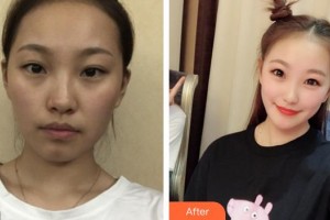 運(yùn)城愛爾眼科醫(yī)院陳鵬整形價格表附激光祛斑案例展示