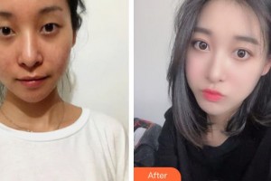 運(yùn)城愛(ài)爾眼科醫(yī)院劉斌虎整形價(jià)格表附開(kāi)內(nèi)眼角案例展示