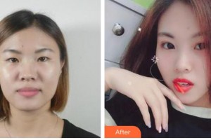 運(yùn)城愛(ài)爾眼科醫(yī)院寧英慧整形價(jià)格表附切開(kāi)雙眼皮案例展示