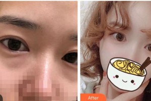 運(yùn)城愛(ài)爾眼科醫(yī)院王寧整形價(jià)格表附內(nèi)切祛眼袋案例展示