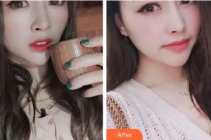 運(yùn)城愛(ài)爾眼科醫(yī)院行磊整形價(jià)格表附內(nèi)切祛眼袋案例展示