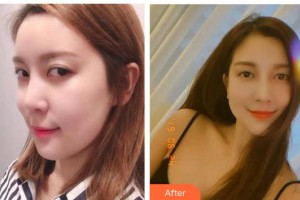 運(yùn)城愛(ài)爾眼科醫(yī)院魏潤(rùn)梅整形價(jià)格表附眼部修復(fù)案例展示