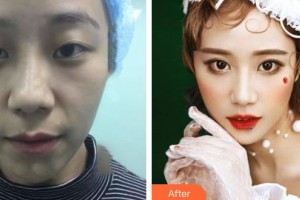 運(yùn)城愛爾眼科醫(yī)院樊曉娟整形價格表附切開雙眼皮案例展示