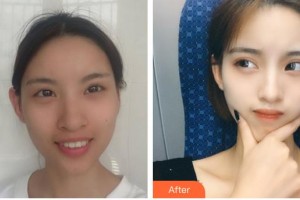 運(yùn)城愛(ài)爾眼科醫(yī)院李冬年整形價(jià)格表附眼部綜合案例展示