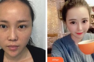 運(yùn)城愛(ài)爾眼科醫(yī)院賈保平整形價(jià)格表附眼部修復(fù)案例展示