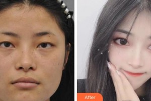 運(yùn)城愛(ài)爾眼科醫(yī)院高巖整形價(jià)格表附眼部綜合案例展示