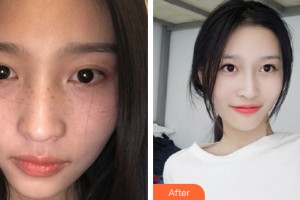 西寧欣怡醫(yī)學(xué)整形美容門診部王娜整形價格表附皮膚美容案例展示