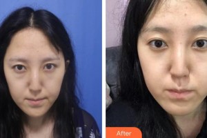 運(yùn)城市眼科醫(yī)院許衛(wèi)玲整形價(jià)格表附切開(kāi)雙眼皮案例展示