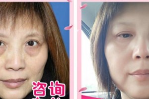 運(yùn)城市眼科醫(yī)院潘秀紅整形價(jià)格表附激光去眼袋案例展示