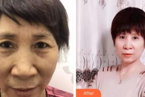 運(yùn)城市眼科醫(yī)院黃淑芳整形價(jià)格表附切眉術(shù)案例展示