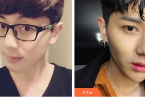 運(yùn)城市眼科醫(yī)院李麗麗整形價(jià)格表附眼部綜合案例展示