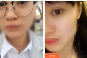 運(yùn)城愛(ài)爾眼科醫(yī)院張小紅整形價(jià)格表附切開(kāi)雙眼皮案例展示