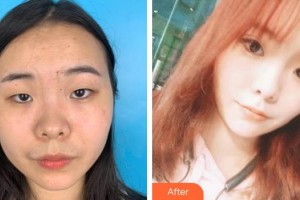 運(yùn)城市眼科醫(yī)院付明山整形價(jià)格表附定點(diǎn)雙眼皮案例展示