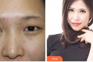 運(yùn)城市眼科醫(yī)院李文俊整形價(jià)格表附眼部綜合案例展示