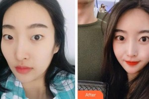 運(yùn)城市眼科醫(yī)院李曉梅整形價(jià)格表附眼部綜合案例展示