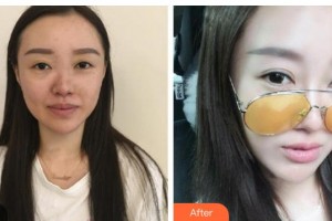 運(yùn)城市眼科醫(yī)院范雷波整形價(jià)格表附眼部綜合案例展示