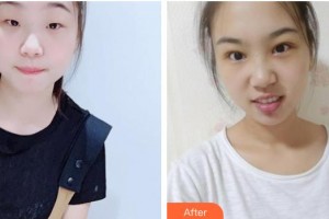 運(yùn)城愛(ài)爾眼科醫(yī)院賈穎麟整形價(jià)格表附切開(kāi)雙眼皮案例展示