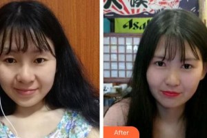 運(yùn)城市眼科醫(yī)院趙斌整形價(jià)格表附切開(kāi)雙眼皮案例展示