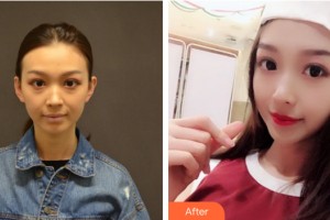 南昌佳美美容醫(yī)院吳溯帆整形價格表附自體脂肪填充案例展示