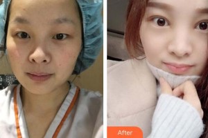 臨汾市堯都區(qū)眼科醫(yī)院楊張榮整形價格表附開內(nèi)眼角案例展示