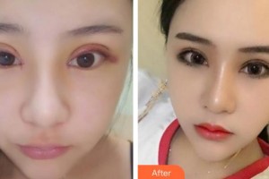 臨汾市堯都區(qū)眼科醫(yī)院王雙喜整形價(jià)格表附外切祛眼袋案例展示