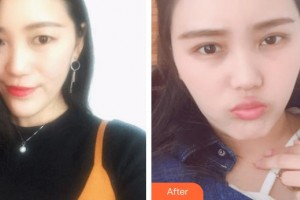 臨汾市堯都區(qū)眼科醫(yī)院梁慧琴整形價格表附眼部綜合案例展示