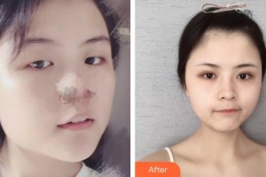 臨汾麗都整形美容門診部李翔宇整形價(jià)格表附切開雙眼皮案例展示