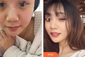 臨汾麗都整形美容門診部劉磊整形價格表附假體隆鼻案例展示