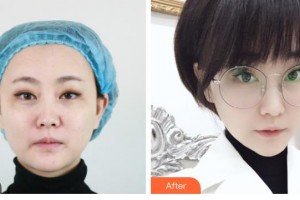 臨汾佳美醫(yī)療整形醫(yī)院韓江立整形價(jià)格表附激光祛斑案例展示