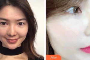 內(nèi)蒙古王成毅醫(yī)療整形美容醫(yī)院烏蘭哈斯整形價(jià)格表附美白導(dǎo)入案例展示